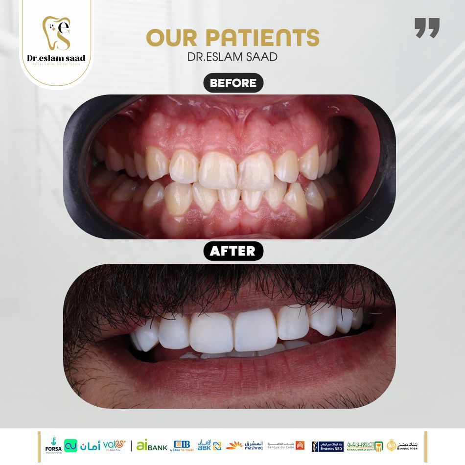 before-after-composite-veneers