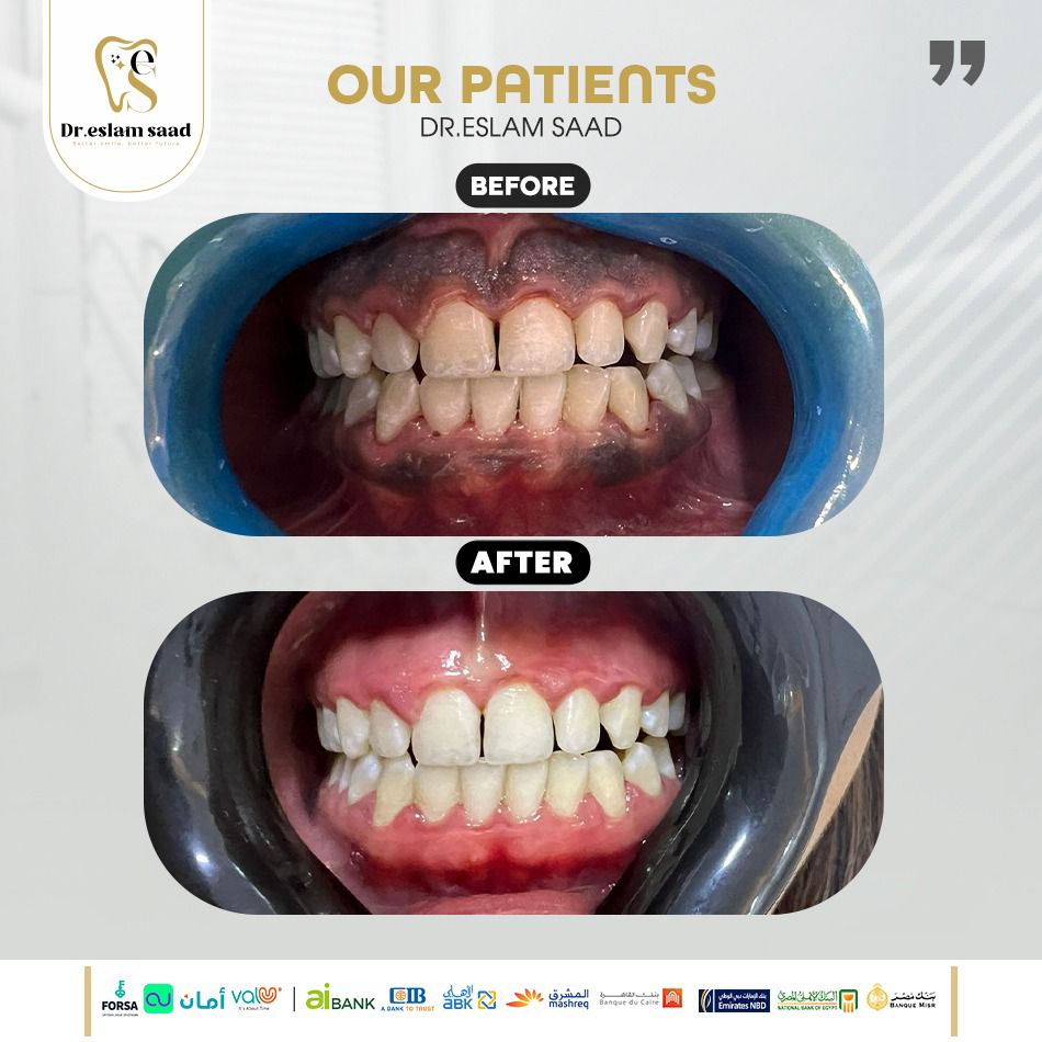 تجميل اللثه دكتور اسلام سعد